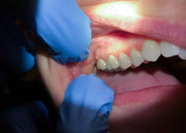 Best Emergency Dentist for Lost Fillings or Crowns in Brundidge, AL